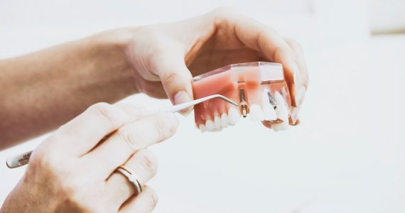 dental-implants-4